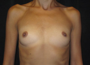 Breast Augmentation