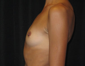 Breast Augmentation Case 887 Before Photo Breast Augmentation