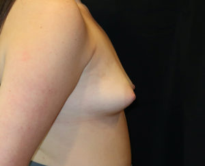 Breast Augmentation Case 876 Before Photo Breast Augmentation