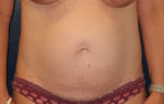 Tummy Tuck