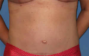 Tummy Tuck Case 918 After Photo Tummy Tuck