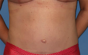 Tummy Tuck