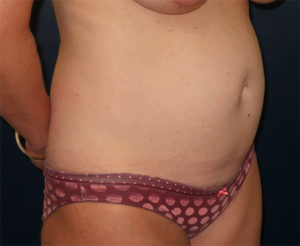 Tummy Tuck