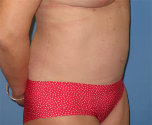 Tummy Tuck