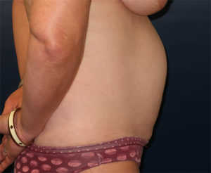 Tummy Tuck Case 918 Before Photo Tummy Tuck