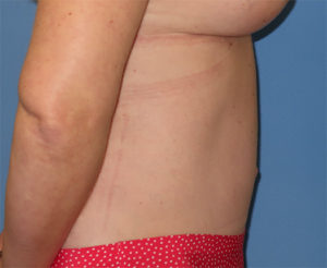 Tummy Tuck Case 918 After Photo Tummy Tuck