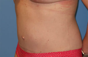 Tummy Tuck Case 918 After Photo Tummy Tuck