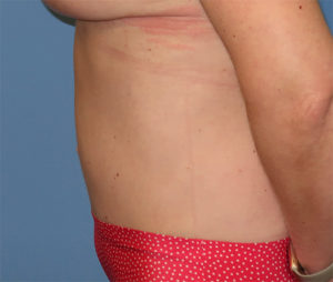 Tummy Tuck Case 918 After Photo Tummy Tuck