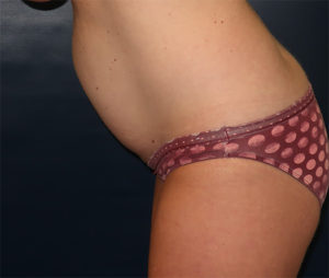 Tummy Tuck Case 918 Before Photo Tummy Tuck