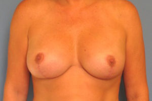 Breast Implants with Lift Case 854 After Photo Breast Implants with Lift
