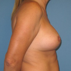 Breast Implants with Lift Case 854 After Photo Breast Implants with Lift