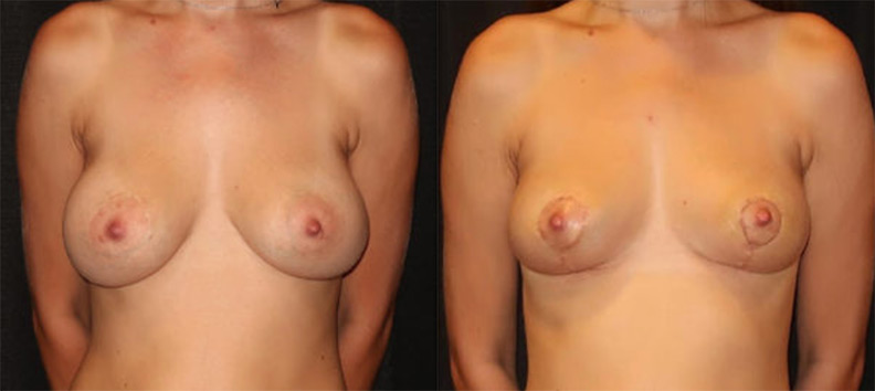 Breast enlarge surgery - Nude pics