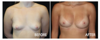 Breast Procedures