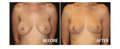Breast Fat Transfer Surgery
