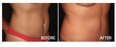 Tummy Tuck