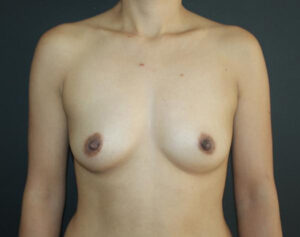 Breast Augmentation Before and After Gallery Case 1051 Before Photo Breast Augmentation Before and After Gallery