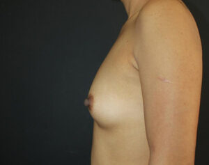 Breast Augmentation Before and After Gallery Case 1051 Before Photo Breast Augmentation Before and After Gallery