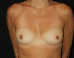 Breast Augmentation