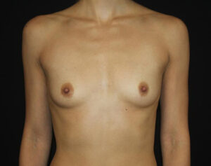 Breast Augmentation