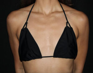 Breast Augmentation Before and After Gallery