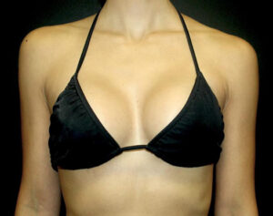 Breast Augmentation Before and After Gallery