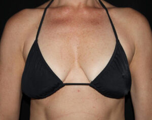 Breast Augmentation Before and After Gallery Case 1054 Before Photo Breast Augmentation Before and After Gallery