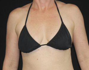 Breast Augmentation Before and After Gallery
