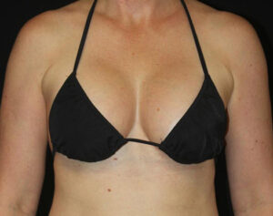 Breast Augmentation Before and After Gallery