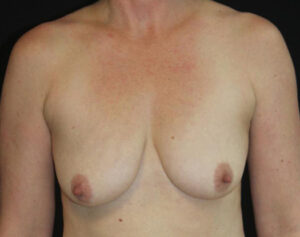 Breast Augmentation Before and After Gallery