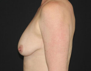 Breast Augmentation Before and After Gallery