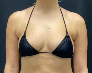 Breast Augmentation Before and After Gallery