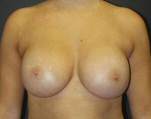 Breast Augmentation Before and After Gallery