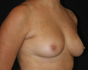 Breast Augmentation Before and After Gallery