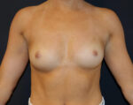 Breast Augmentation