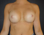 Breast Augmentation