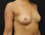 Breast Augmentation