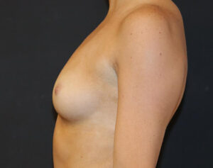 Breast Augmentation Case 1137 Before Photo Breast Augmentation
