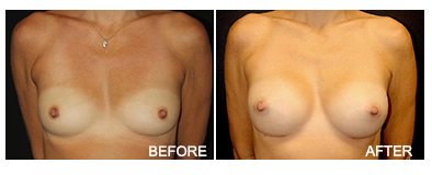 Breast Procedures