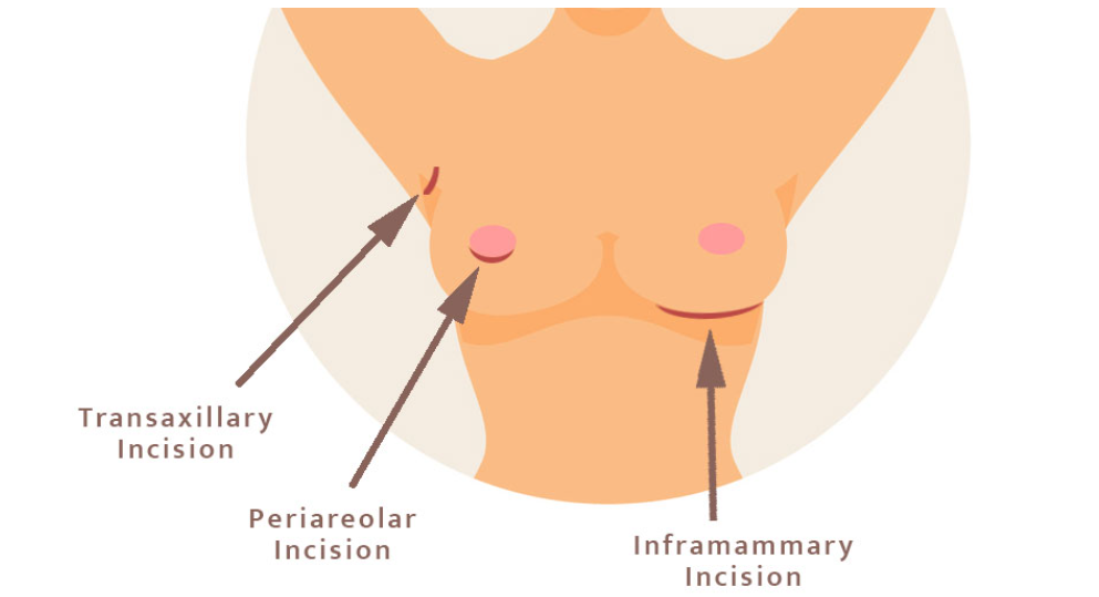 Breast augmentation incisions locations