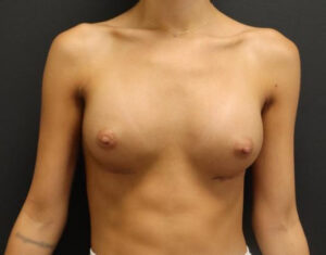 Breast Augmentation Before and After Gallery