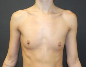 Breast Augmentation Before and After Gallery