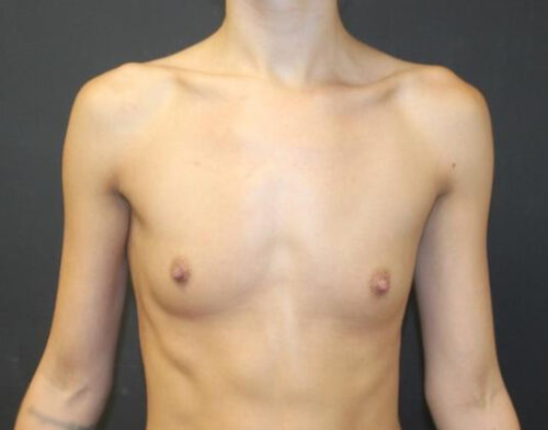 Breast Augmentation Before and After Gallery