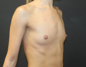Breast Augmentation Before and After Gallery