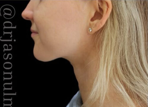 Submental Liposuction Before and After Gallery