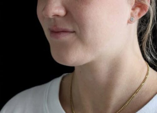 Submental Liposuction Before and After Gallery