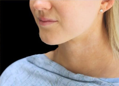 Submental Liposuction Before and After Gallery