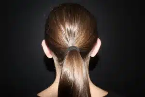 Ear Surgery Before and After Gallery