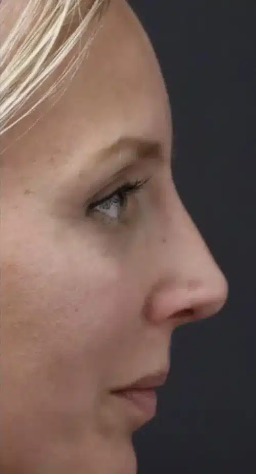 Rhinoplasty Before and After Gallery