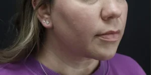 Submental Liposuction Before and After Gallery