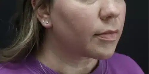 Submental Liposuction Before and After Gallery